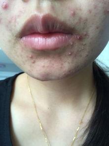 吃籽瓜长痘痘吗,揭秘籽瓜对皮肤的影响