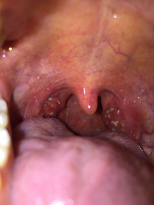 喉咙结节可以吃瓜吗,瓜类食物的食用指南